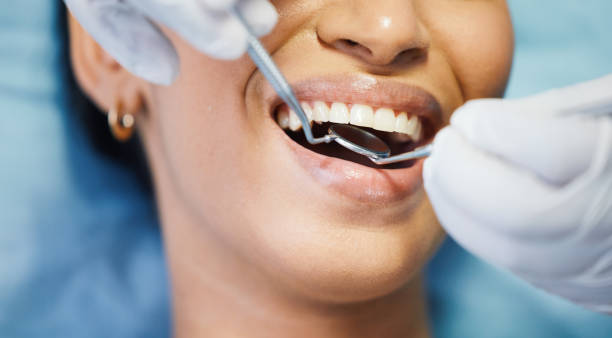 Best Knocked-Out Tooth (Avulsed Tooth) Treatment in Mountain City, GA